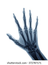 Xray Image Human Hands Stock Photo 372787171 | Shutterstock