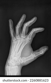X-ray image of human hands, arm fracture - Shutterstock ID 2260881623