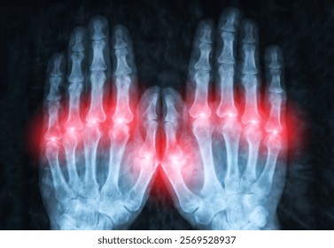 X-Ray Image of Human hands bones. Skeletal structure for medical analysis of osteoarthritis, muscular dystrophy and stroke. Inflammation of the joints on the hands.