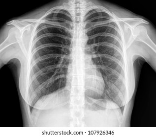 X-Ray Image Of Human Healthy Chest MRI