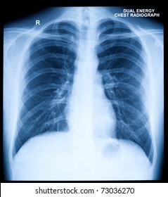 Normal Chest Xray Images Stock Photos Vectors Shutterstock