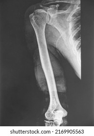 X-ray image of human humerus