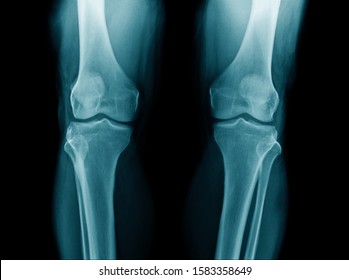 x-ray image of human knee both side  