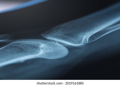 X-ray image of human knee. Problems with bone or joint.