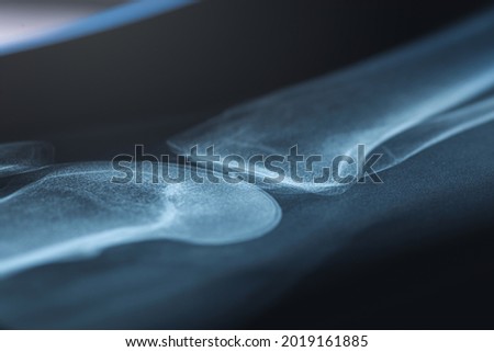 X-ray image of human knee. Problems with bone or joint.