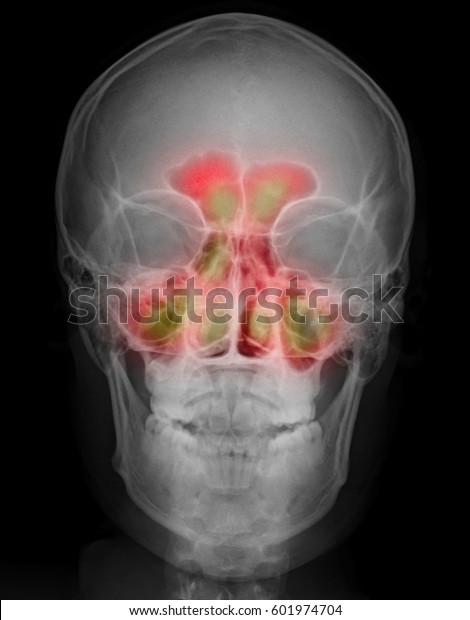 Xray Image Human Skull Paranasal Sinuses Stock Photo Edit Now