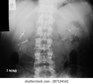X-ray image of Intravenous Pyelogram (IVP), 3 minute post injection of contrast media.