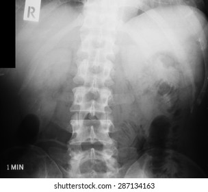 X-ray Image Of Intravenous Pyelogram (IVP), 1 Minute Post Injection Of Contrast Media.