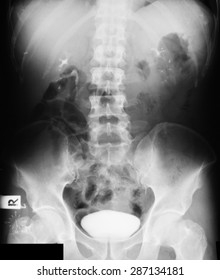 X-ray image of Intravenous Pyelogram (IVP), 27minutes post injection of contrast media.