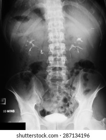 X-ray Image Of Intravenous Pyelogram (IVP), 10 Minutes Post Injection Of Contrast Media, Prone Position.