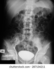 X-ray image of Intravenous Pyelogram (IVP), full bladder