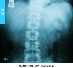 X-ray Image Of Intravenous Pyelogram (IVP), 1 Minute Post Injection Of Contrast Media.