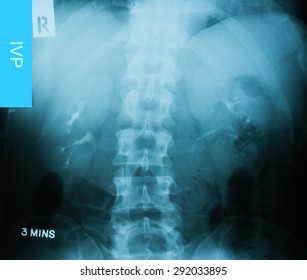 X-ray Image Of Intravenous Pyelogram (IVP), 3 Minute Post Injection Of Contrast Media.