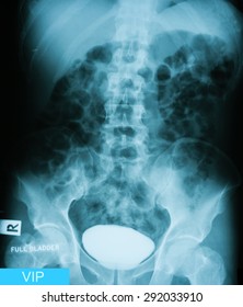 X-ray image of Intravenous pyelogram (IVP), full blader