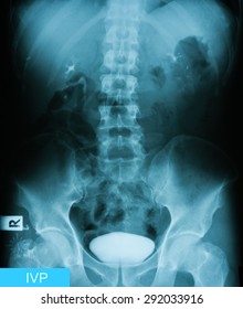 X-ray Image Of Intravenous Pyelogram (IVP), 27minutes Post Injection Of Contrast Media.