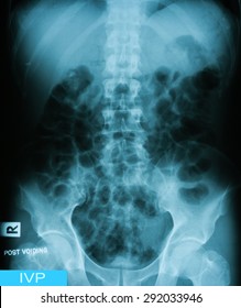 X-ray image of Intravenous pyelogram (IVP), post voiding.