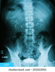 X-ray image of Intravenous pyelogram (IVP),10 minutes post injection of contrast media.