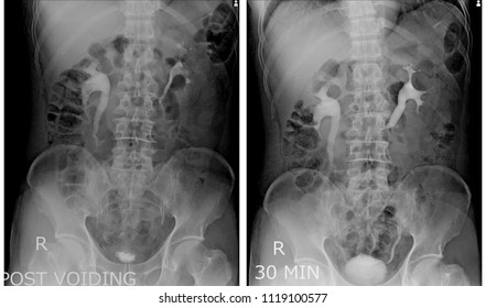  X-ray image Intravenous Pyelography(IVP),Special urinary tract examination.