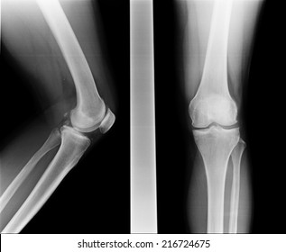 X-ray image Knee