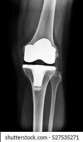 X-ray Image Knee After Total Knee Arthroplasty Front View