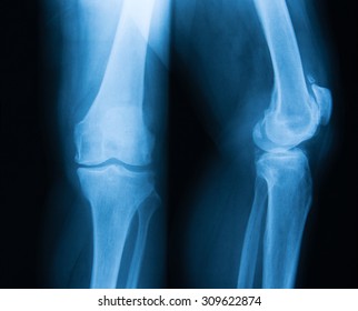 Anterolateral Xray Radiograph Showing Severe Stage Stock Photo 