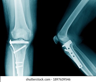 X-ray Image Of Knee, Tibia Fracture With Post Operation Internal Fixation 