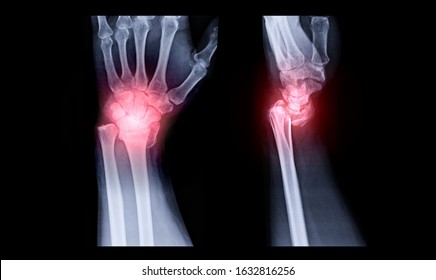 X-ray image of Left wrist joint AP and Lateral view for showing fracture of radius bone. - Shutterstock ID 1632816256