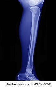 x-ray image of leg side view , xray of normal leg bone in adult