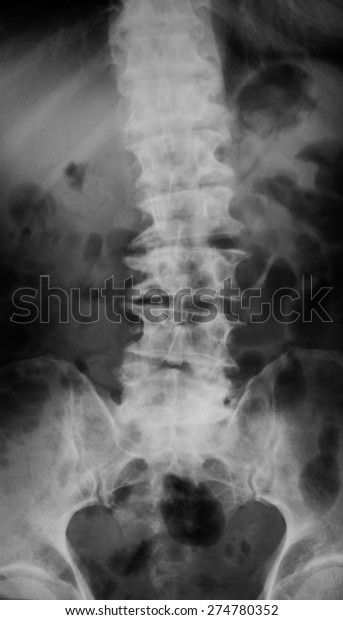 Xray Image Ls Spine Ap View Stock Photo 274780352 | Shutterstock