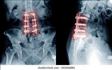 X-ray Image Of Lumbar Spine Postoperative Treatment For Degenerative Lumbar Disc Disease
By Decompression And Fix By Iron Rod And Screws