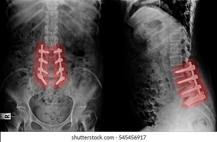 X-ray Image Of Lumbar Spine Postoperative Treatment For Degenerative Lumbar Disc Disease
By Decompression And Fix By Iron Rod And Screws