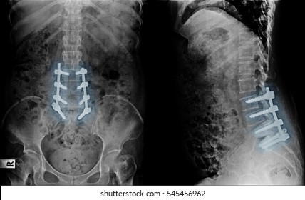 316 Spinal fusion x ray Images, Stock Photos & Vectors | Shutterstock