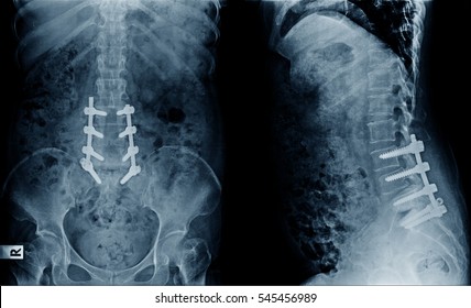 Xray Image Lumbar Spine Postoperative Treatment Stock Photo 545456989 ...