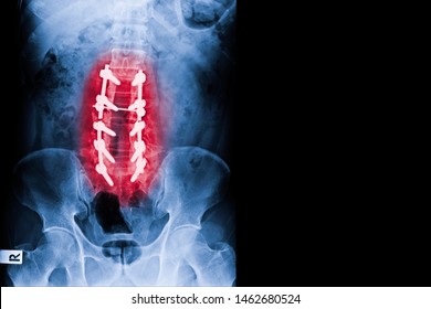 X-ray Image Of Lumbar Spine Show Spinal Stenosis Treated By Decompressive Laminectomy With Fusion Bone Graft And Fixation With Pedicle Screw And Rod . Medical Health Care Concept.