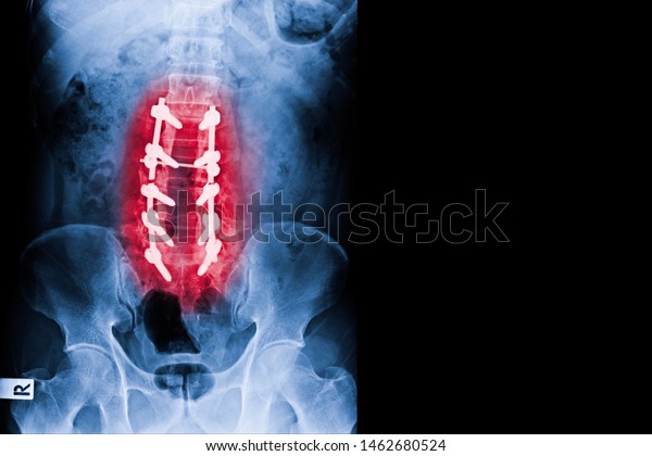 X-ray image of
lumbar spine show spinal stenosis treated by decompressive
laminectomy with fusion bone graft and fixation with pedicle screw
and rod . Medical health care
concept.