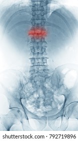 X-ray Image Of Lumbosacral Spine, Osteoporosis Vertebral Compression Fracture With Cord Compression( At The 1st Lumbar Vertebra), Anteroposterior (AP) View