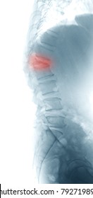 X-ray Image Of Lumbosacral Spine, Osteoporosis Vertebral Compression Fracture With Cord Compression( At The 1st Lumbar Vertebra), Lateral View