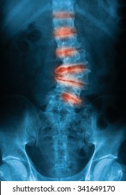 X-ray Image Of Lumbo-sacral Spine Showing Osteoarthritis Of Lumbar.