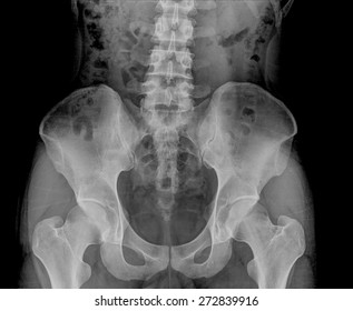 X-RAY Image Of Male Pelvis With Osteoporosis