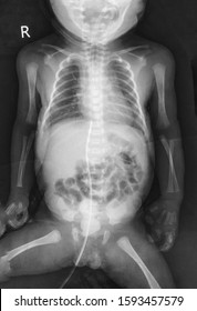 X-ray image of newborn baby chest included abdomen supine position shows enteric tube with its tip at stomach. UVC with its tip IVC/RA junction. Diffused bilateral ground glass opacity in both lunges.