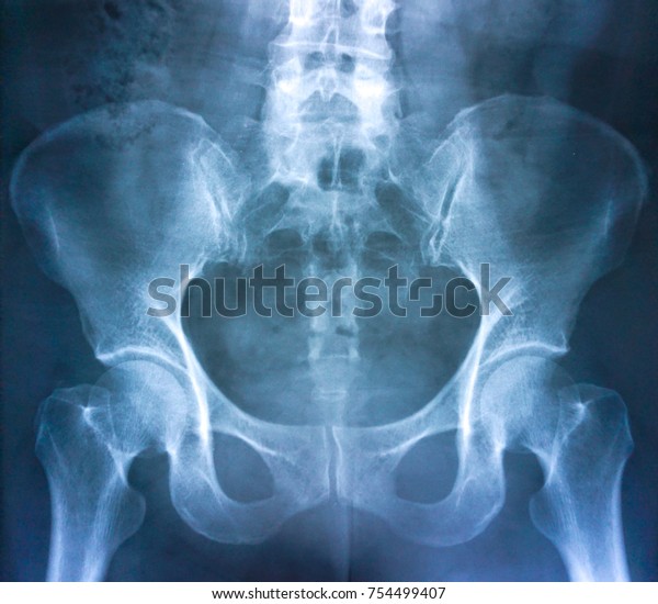 normal xray of hips
