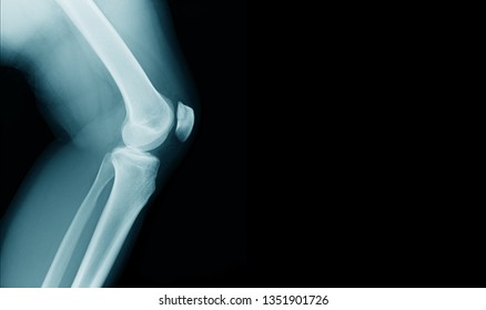 x-ray image of OA knee with banner design
