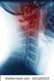 X-ray image of Occipital pain, lateral view