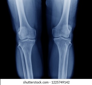 x-ray image old patient with degenerative change of knee joint, OA knee x-ray image PA view in blue tone and black background