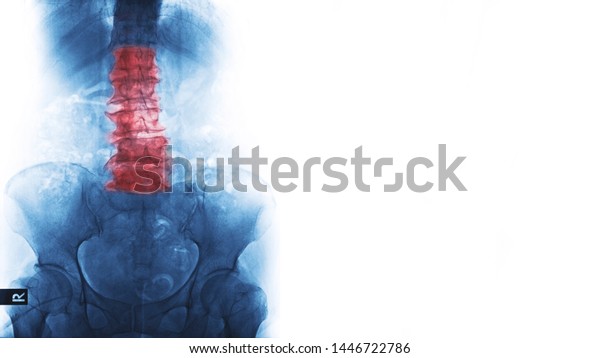 X-ray image of patient show ankylosing spondylitis\
degenerative change of human spine and pelvic bone deformity and\
compression fracture at red area mark. Medical health care concepts\
with copy space.
