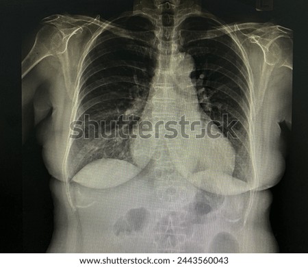 X-ray image of  patient's chest