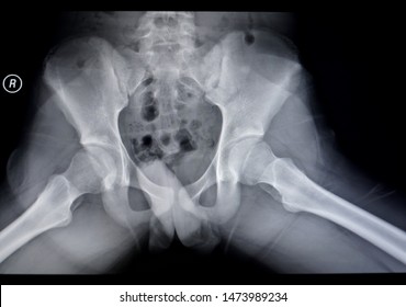 X-ray image pelvis and hip                               