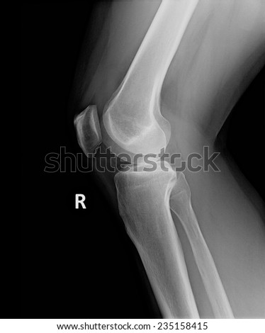 X Ray Image Perfect Right Knee Leg Stock Photo (Edit Now) 235158415 ...