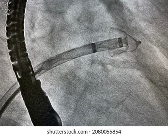 X-ray image performed left atrial appendage occluder device in patient who has thrombus in left atrial appendage (LAA), Left atrial appendage closure procedures. - Shutterstock ID 2080055854