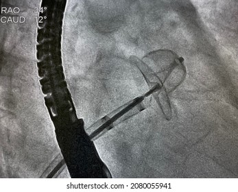 X-ray image performed left atrial appendage occluder device in patient who has thrombus in left atrial appendage (LAA), Left atrial appendage closure procedures. - Shutterstock ID 2080055941